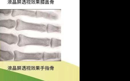 Live fluoroscopy image — finger phalanges